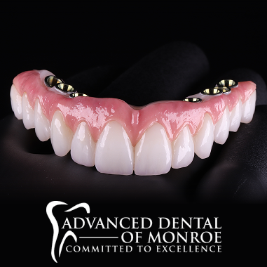 Hybrid Implant Bridge