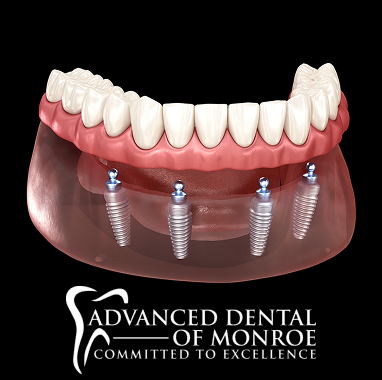 Zirconia Implant Bridge