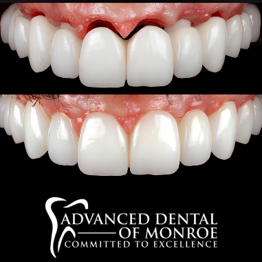 Porcelain Implant Bridge